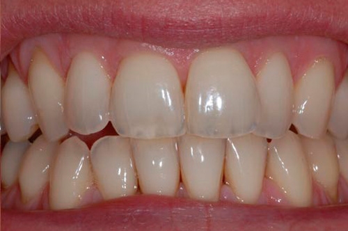 Почему появляется трещина в эмали зуба