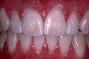 Причины нарушения целостности эмали зубов