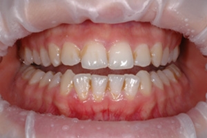 Микроабразия: эффективный метод удаления пятен на зубной эмали