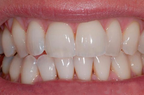 Лечение трещин в зубах цена