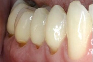 Клиновидный дефект на зубах - фото до лечения