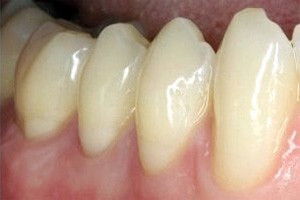 Клиновидный дефект зубов - фото после лечения